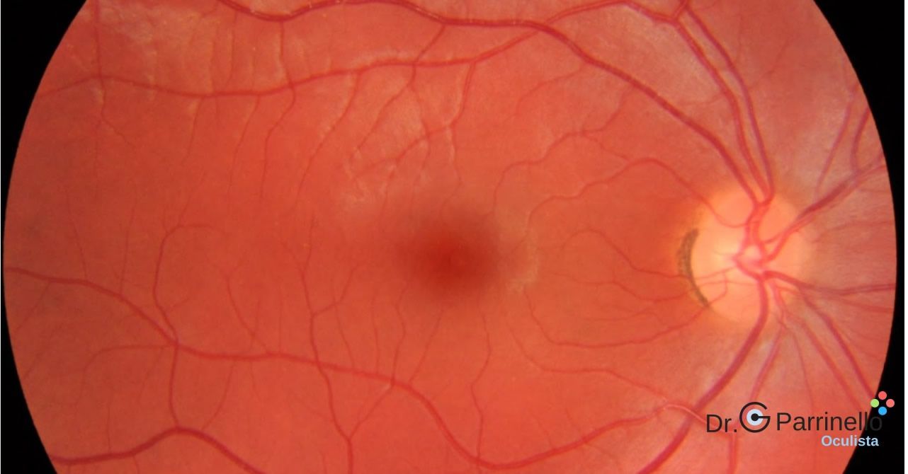 Retinografia Diagnosi ed esami visivi - oculista Marsala Retinografia