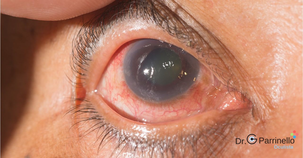 Glaucoma Patologie dell'occhio - oculista Marsala Glaucoma