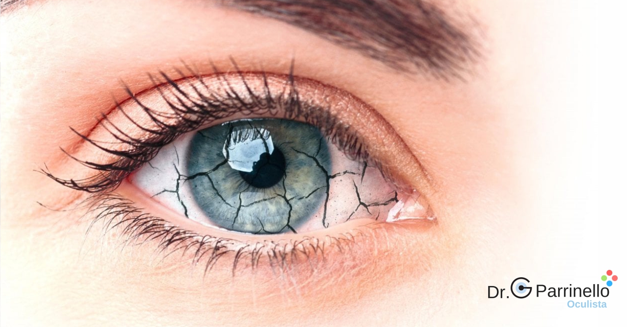 Cos'è la sindrome da occhio secco?