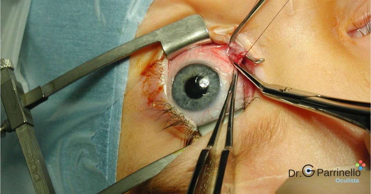 Chirurgia dello strabismo Terapie per patologie oculari - oculista Marsala Chirurgia dello strabismo