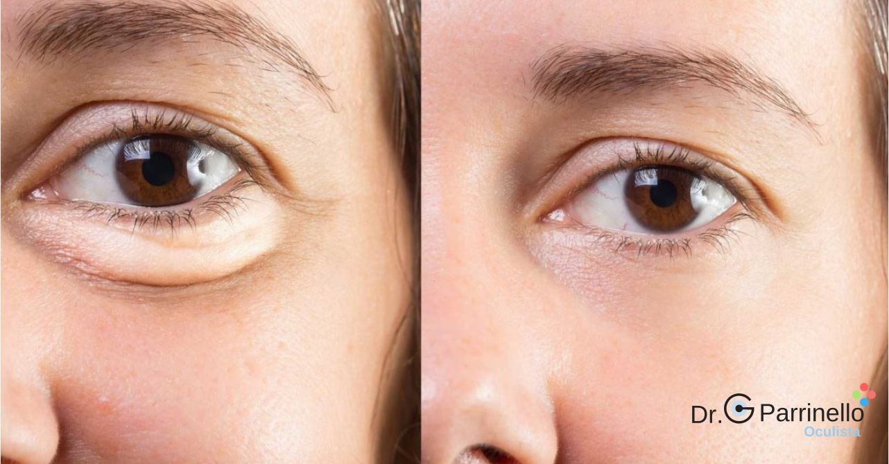 Blefaroplastica Terapie per patologie oculari - oculista Marsala Blefaroplastica
