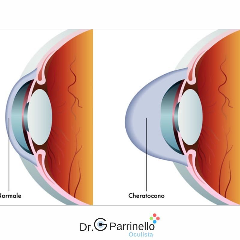 Pachimetria corneale ad ultrasuoni, oculista convenzioanto a Marsala