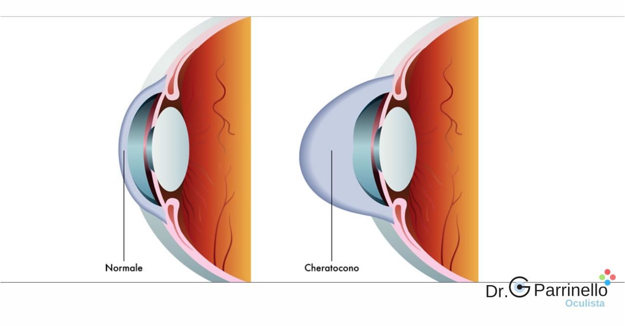 Pachimetria corneale ad ultrasuoni Diagnosi ed esami visivi - oculista Marsala Pachimetria corneale ad ultrasuoni